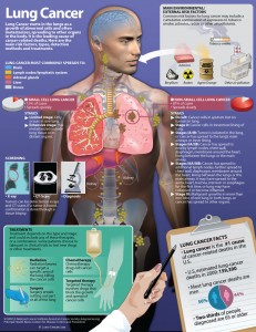 Causes of Lung Cancer