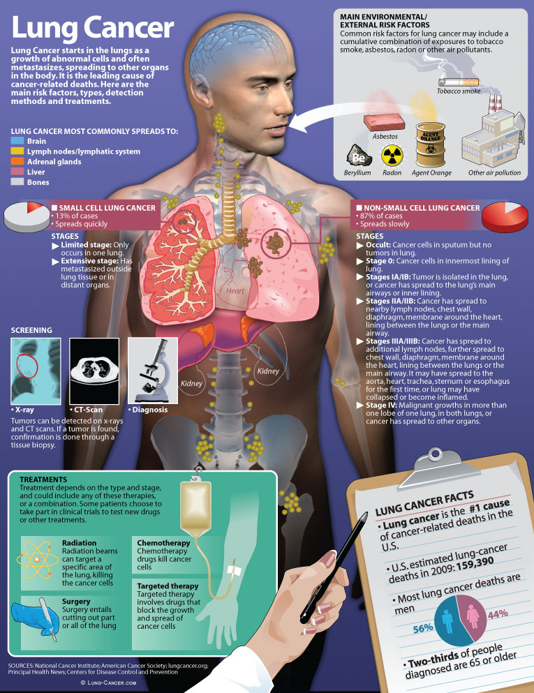 Lung development is a sickness depicted by uncontrolled unit growth in tissues of the lung. Hinging on if left untreated, this improvement can spread past the lung in an approach […]