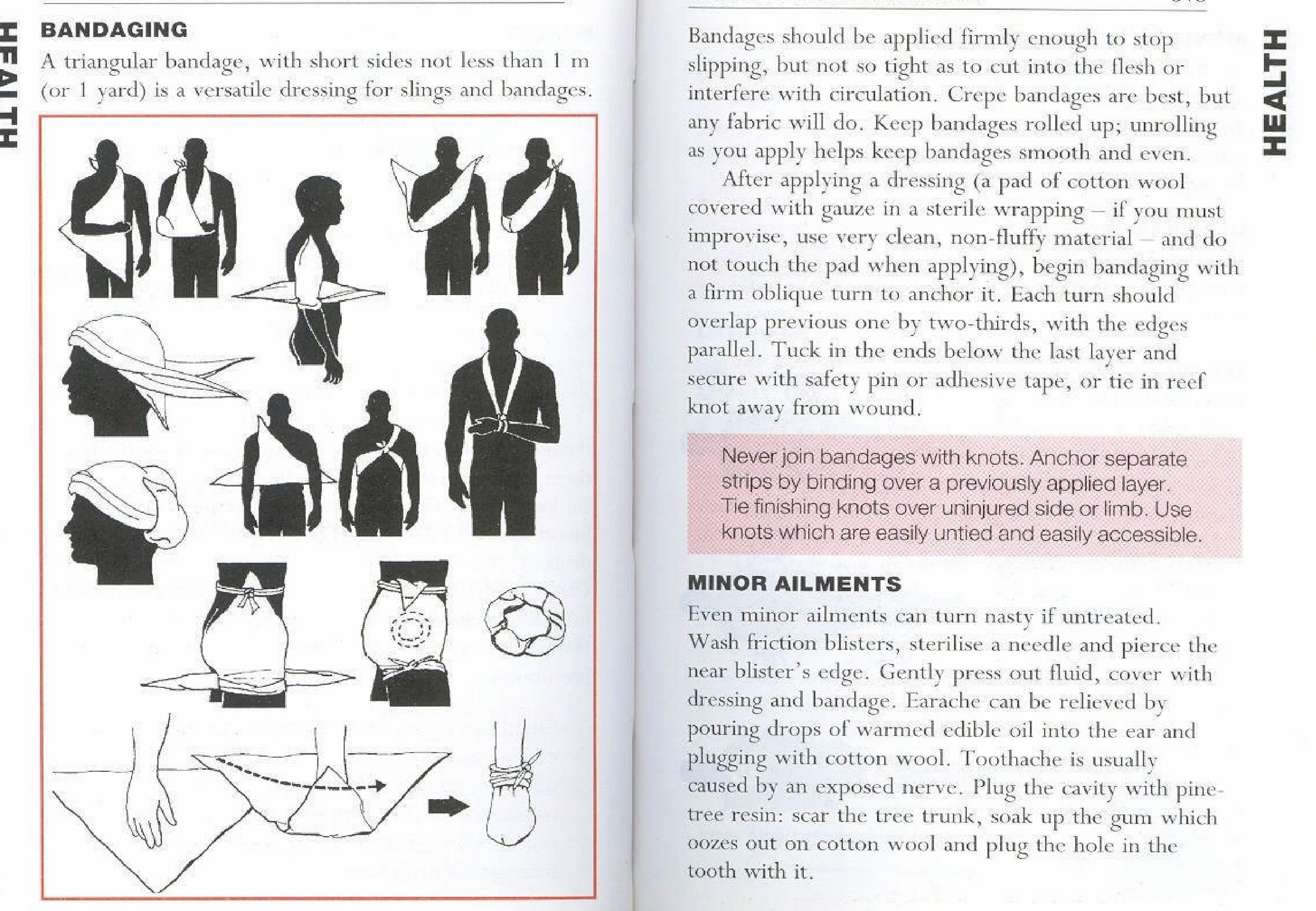 Never join bandages with knots. Anchor separate strips by binding over a previously applied layer. Tie finishing knots over uninjured side or limb. Use knots which are easily untied and […]